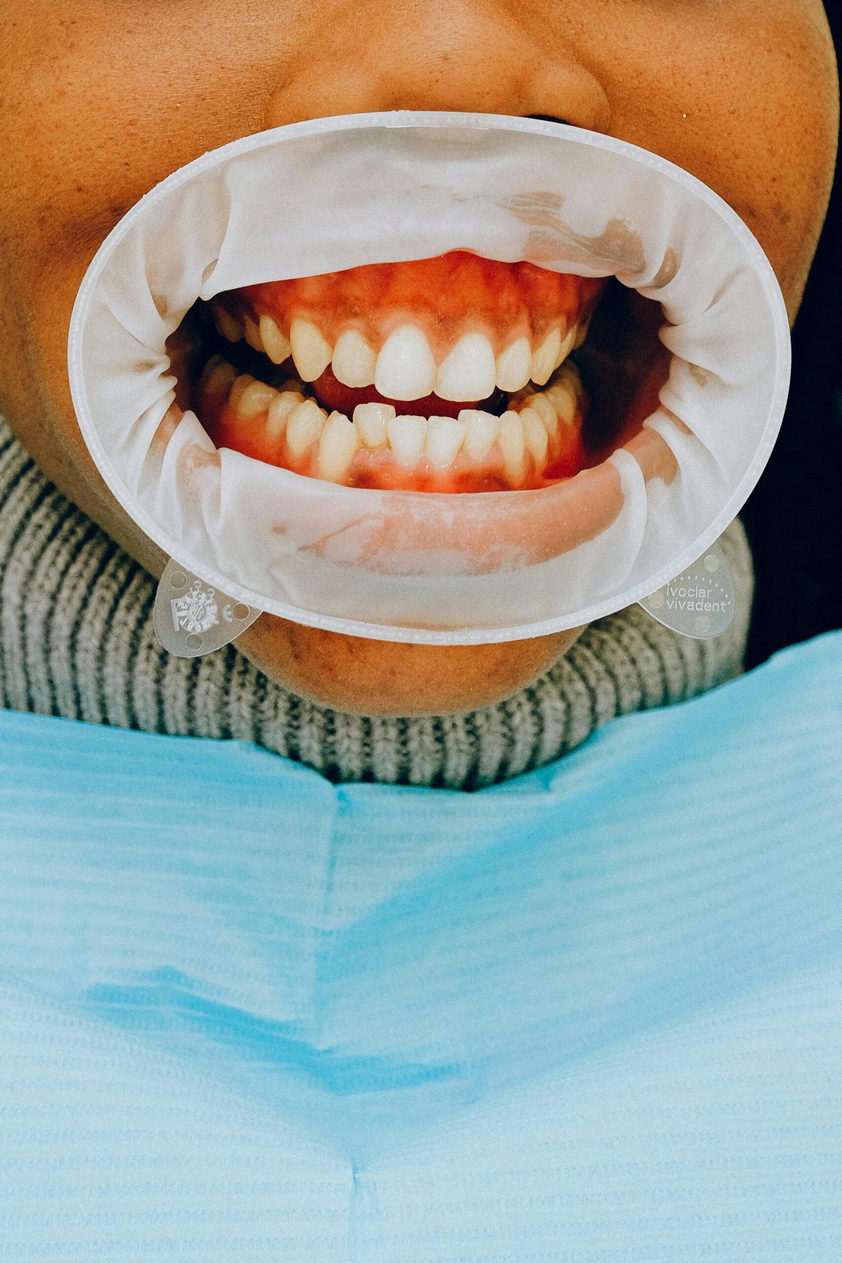 Detailed view of a dental checkup showing teeth with cheek retractor in place.